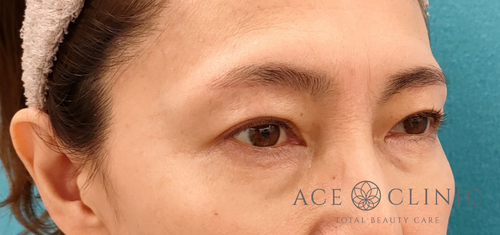 眉毛下切開法・二重瞼埋没法‗目のたるみ治療‗女性症例【エースクリニック】名古屋院・大阪梅田院 (2)