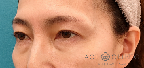 眉毛下切開法・二重瞼埋没法‗目のたるみ治療‗女性症例【エースクリニック】名古屋院・大阪梅田院 (3)