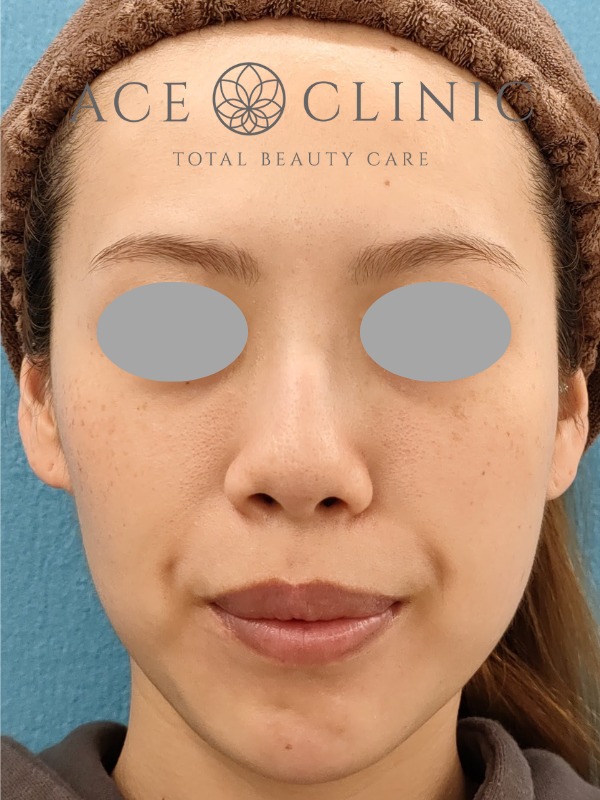 あごプロテーゼ挿入術|症例3|30代女性|術後 正面|エースクリニック大阪梅田HEPナビオ院