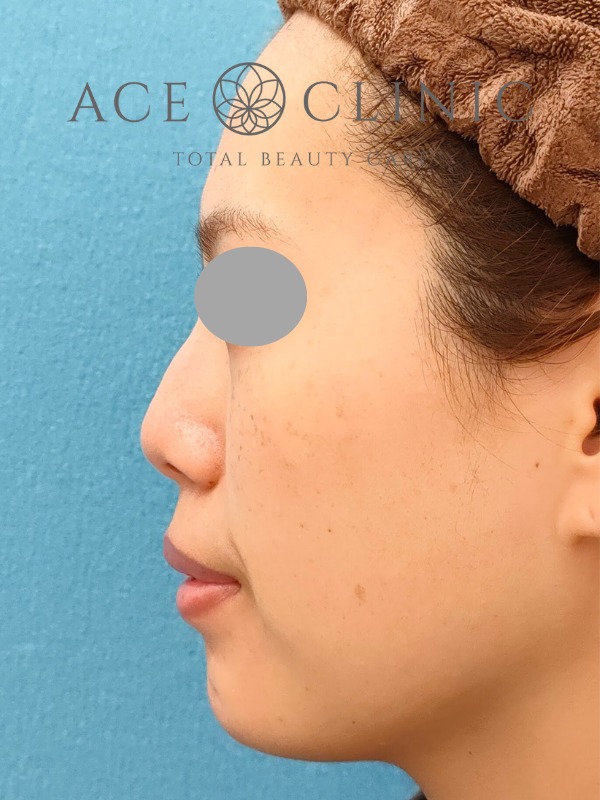 あごプロテーゼ挿入術|症例3|30代女性|術後 左横|エースクリニック大阪梅田HEPナビオ院