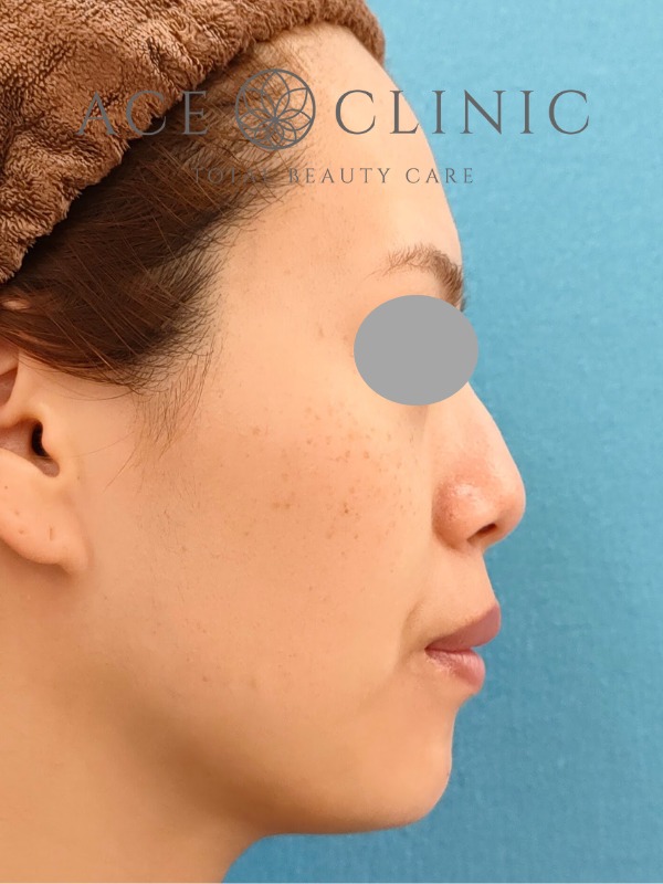 あごプロテーゼ挿入術｜症例3｜30代女性｜術後　右横｜エースクリニック大阪梅田HEPナビオ院