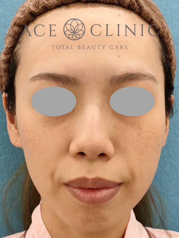 あごプロテーゼ挿入術|症例3|30代女性|術前 正面|エースクリニック大阪梅田HEPナビオ院