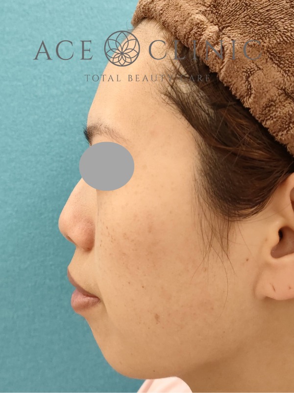 あごプロテーゼ挿入術|症例3|30代女性|術前 左横|エースクリニック大阪梅田HEPナビオ院