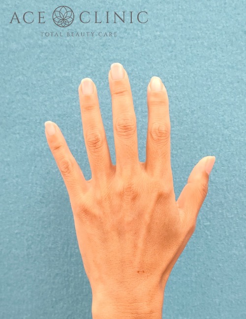 脂肪注入‗手症例_【エースクリニック】名古屋院・大阪梅田院 (2)