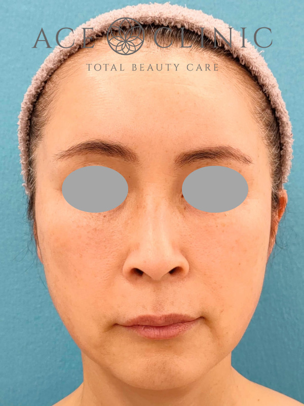 CRF脂肪注入(こめかみ・頬・ほうれい線)|51歳女性|症例7|術後|正面|大阪梅田【エースクリニック】