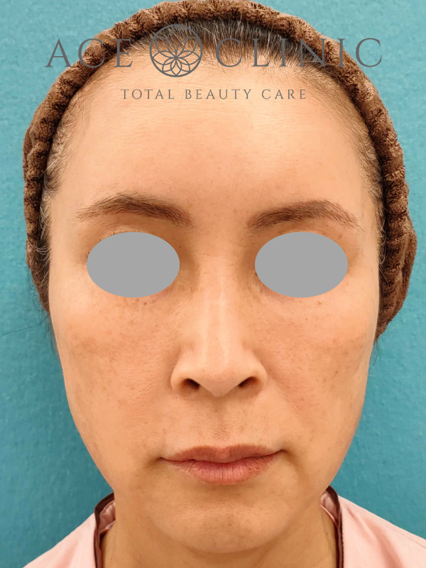 CRF脂肪注入(こめかみ・頬・ほうれい線)|51歳女性|症例7|術前|正面|大阪梅田【エースクリニック】