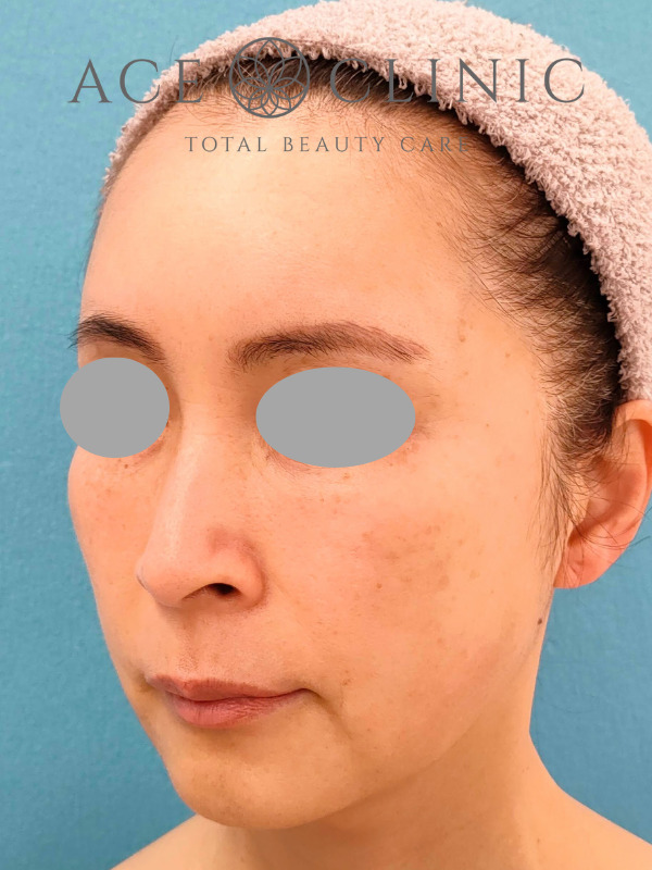 CRF脂肪注入（こめかみ・頬・ほうれい線）｜51歳女性｜症例7｜術後｜左斜め｜大阪梅田【エースクリニック】