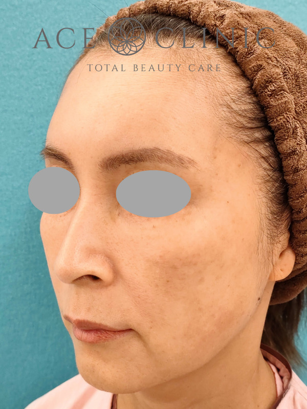 CRF脂肪注入（こめかみ・頬・ほうれい線）｜51歳女性｜症例7｜術前｜左斜め｜大阪梅田【エースクリニック】