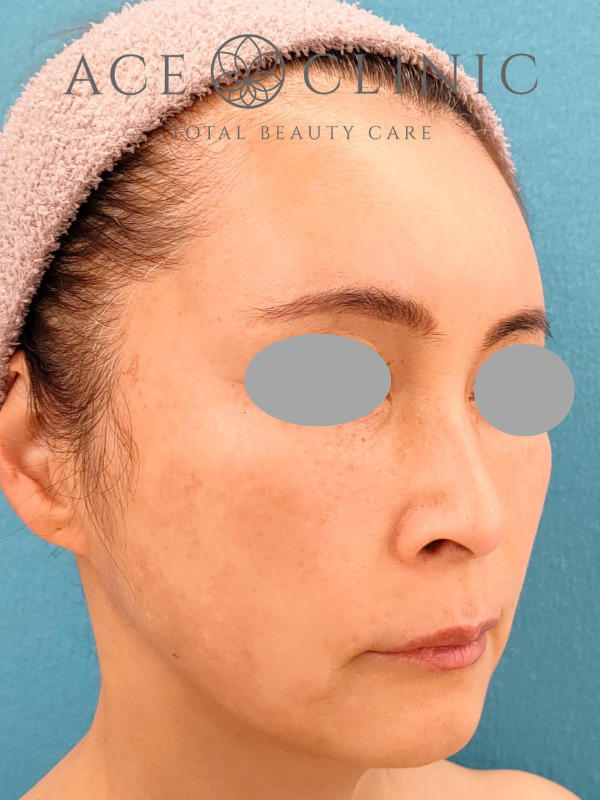 CRF脂肪注入（こめかみ・頬・ほうれい線）｜51歳女性｜症例7｜術後｜右斜め｜大阪梅田【エースクリニック】