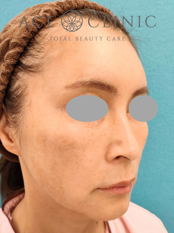 CRF脂肪注入（こめかみ・頬・ほうれい線）｜51歳女性｜症例7｜術前｜右斜め｜大阪梅田【エースクリニック】