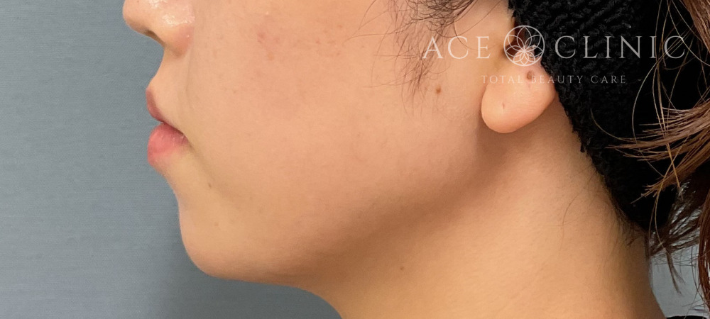 ヒアルロン酸｜症例41｜30代女性｜術後｜エースクリニック大阪梅田HEPナビオ院｜