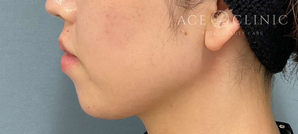 ヒアルロン酸｜症例41｜30代女性｜術前｜エースクリニック大阪梅田HEPナビオ院｜