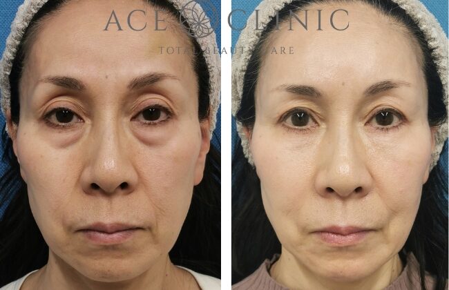 若返りモニターC症例5