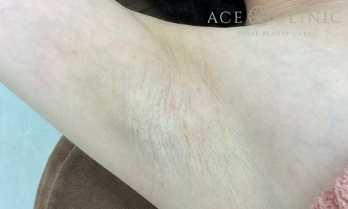 ミラドライ｜症例６｜４0代女性｜術後1ヶ月｜エースクリニック大阪梅田HEPナビオ院