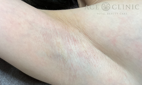 ミラドライ｜症例６｜40代女性｜術前｜エースクリニック大阪梅田HEPナビオ院