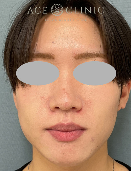 ボトックス注射|症例1|20代男性|術前|エースクリニック大阪梅田HEPナビオ院