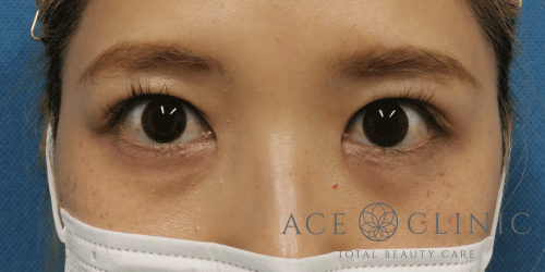 目頭切開法症例