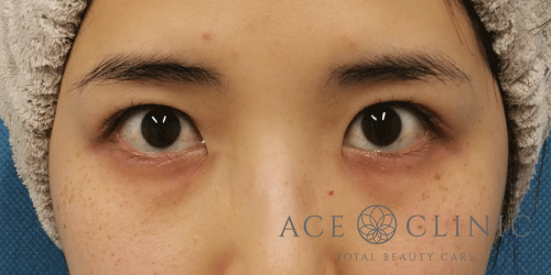 目頭切開法症例