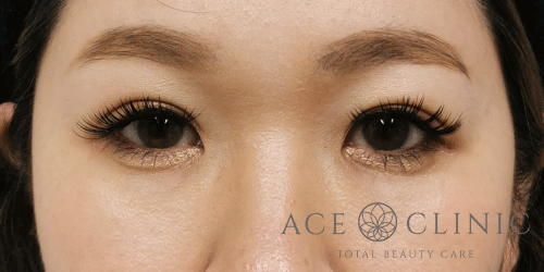 二重埋没法症例