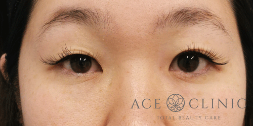 二重埋没法症例