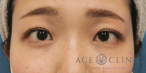 二重瞼埋没法症例