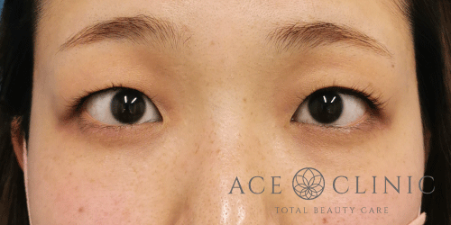 二重瞼埋没法症例