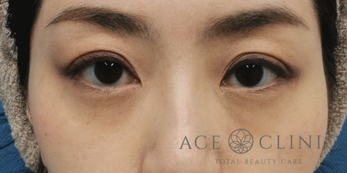 経結膜ハムラ法症例