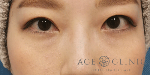 経結膜ハムラ法症例