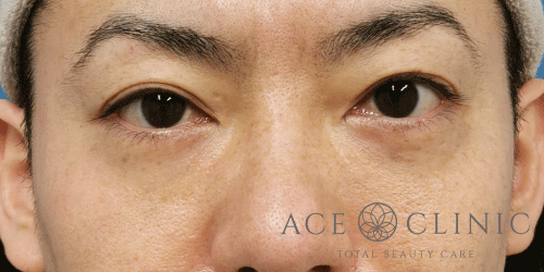 経結膜ハムラ法症例