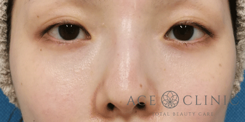 経結膜ハムラ法症例