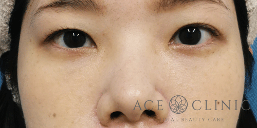 経結膜ハムラ法症例