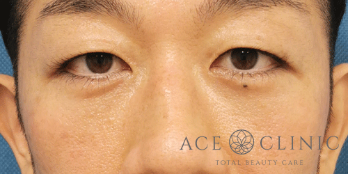 経結膜ハムラ法症例