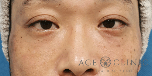 経結膜ハムラ法症例