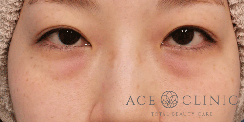 経結膜ハムラ法症例