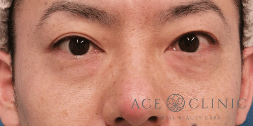 経結膜ハムラ法症例