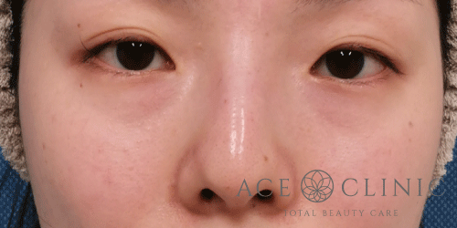 経結膜ハムラ法症例