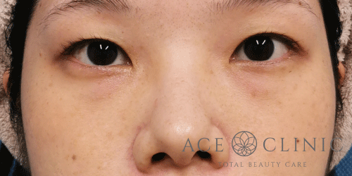 経結膜ハムラ法症例