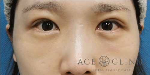 経結膜ハムラ法症例