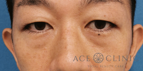 経結膜ハムラ法症例