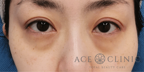 経結膜ハムラ法症例