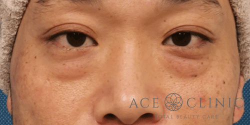 経結膜ハムラ法症例