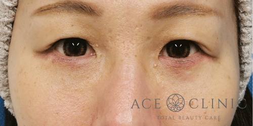 皮切ハムラ法症例