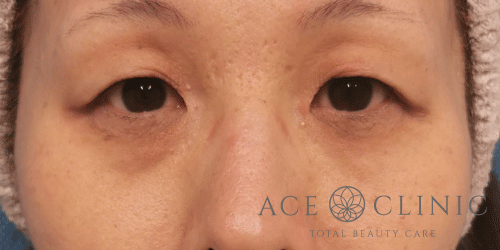 皮切ハムラ法症例