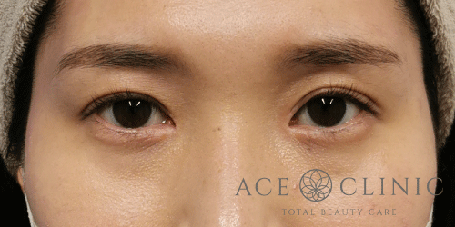 目頭切開法症例