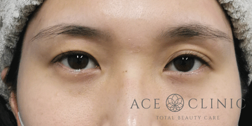 目頭切開法症例