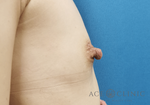 乳頭縮小症例－中山医師