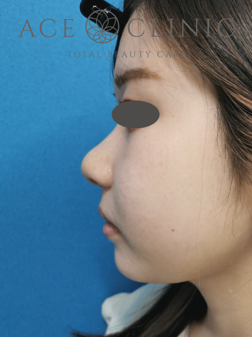 鼻複合手術症例