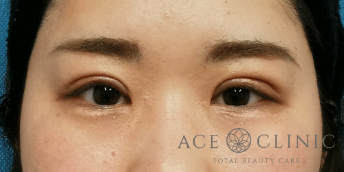 眼瞼下垂症例－中山医師