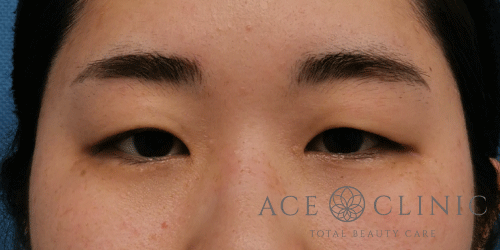 眼瞼下垂症例－中山医師