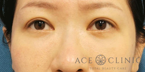 経結膜ハムラ法症例